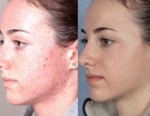 фотографија коже лица након лечења псоријазе